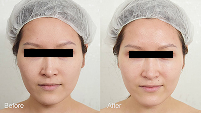 skin-booster