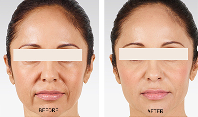 skin booster