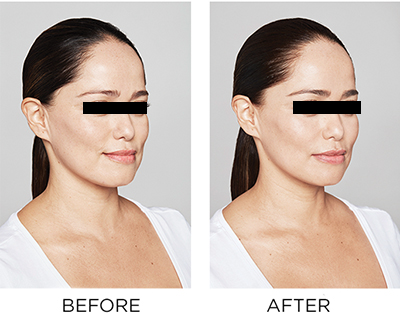 skin booster